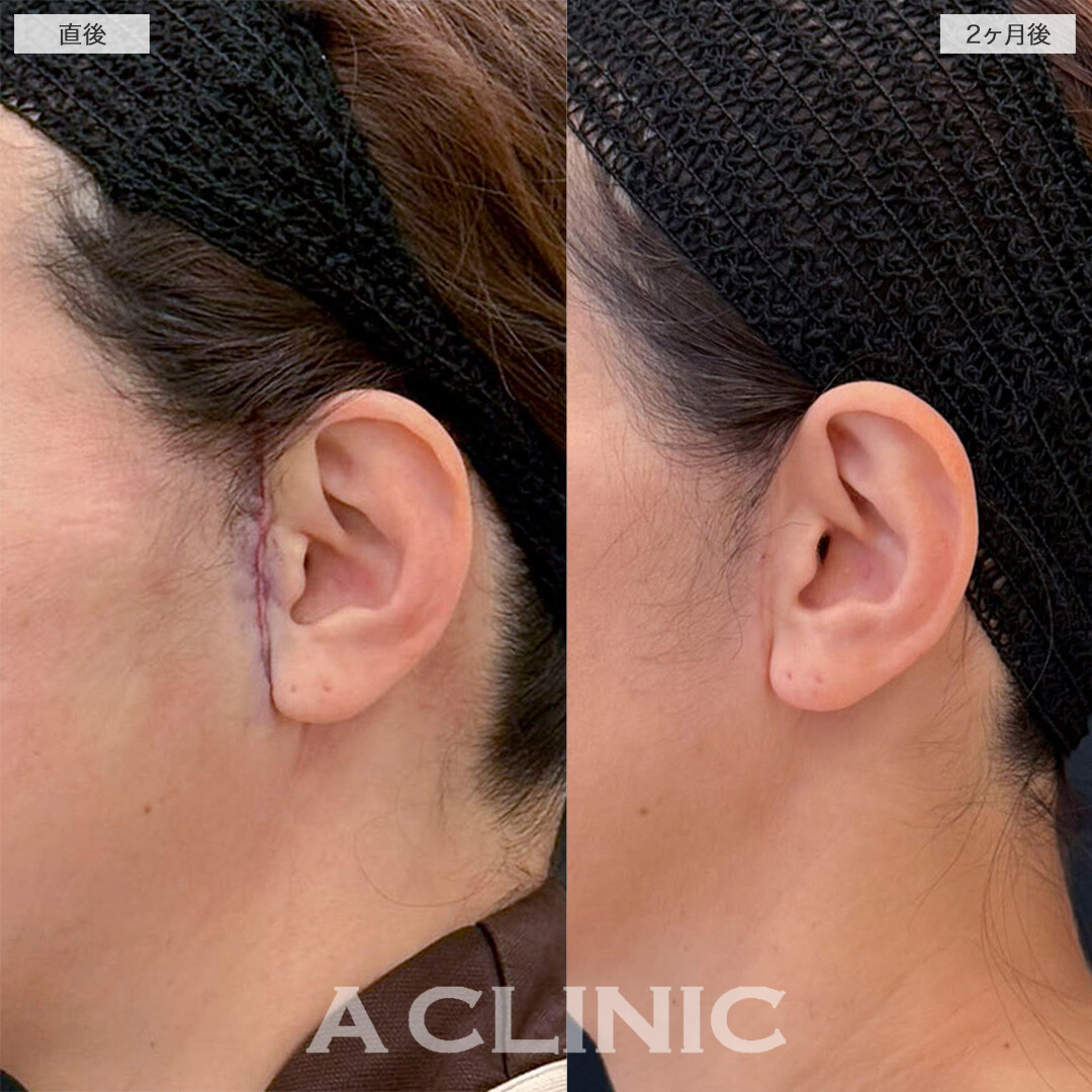 【直後の傷跡あり】A式美肌たるみ切開でマイナス5歳若返った印象に！処置前から2ヶ月後の症例です(40代女性)