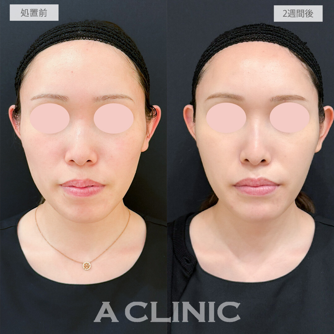 頬とあごへのヒアルロン酸注入とコメカミ形成(ヒアルロン酸注入)で左右差なくなりお顔のバランスが整いました！処置前と2週間後の症例です(20代女性)