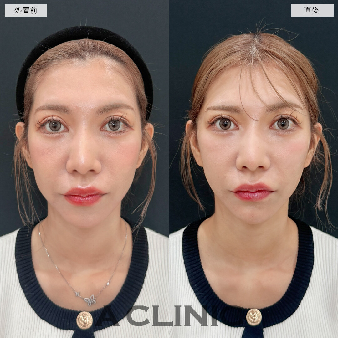 Aスレッドでスッキリフェイスライン！こちら処置前と直後の症例です(30代女性)
