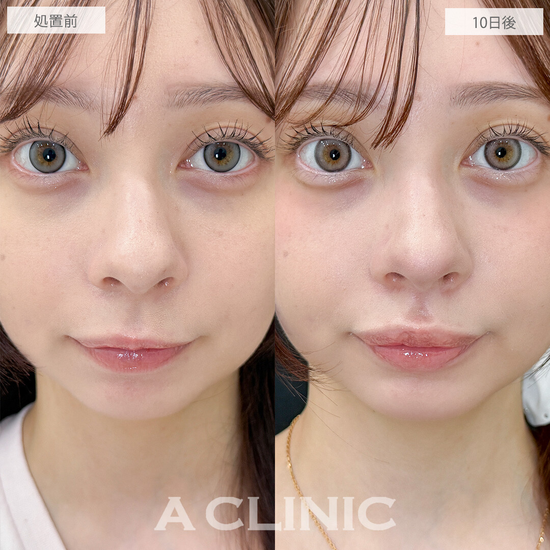 切らない人中短縮(Cカール形成術)なら切開しなくてもここまで人中を短くできます！こちら処置前と10日後の症例です(10代女性)