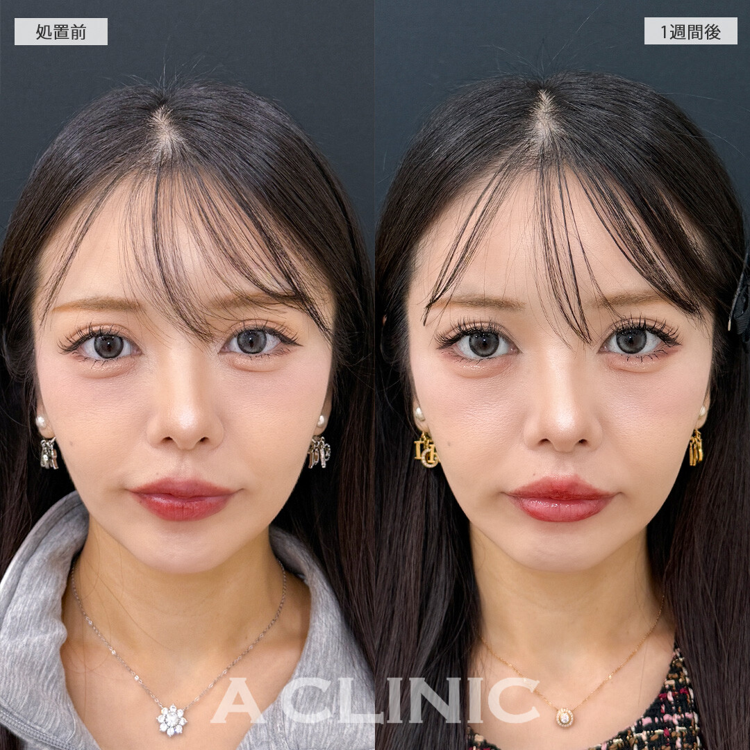 ダウンタイム最小限でしっかり人中が短くなります！切らない人中短縮(Cカール形成術)の処置前と1週間後の症例です(30代女性)