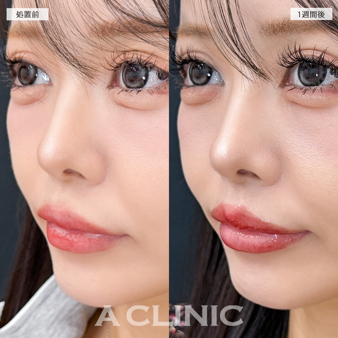 ダウンタイム最小限でしっかり人中が短くなります！切らない人中短縮(Cカール形成術)の処置前と1週間後の症例です(30代女性)