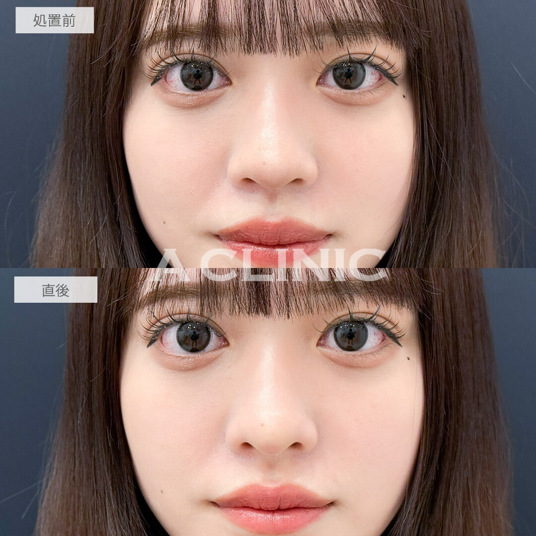 コリアンノーズで鼻先をツンとさせるだけでお顔全体のバランスがより整いました！処置前と直後の症例です(20代女性)
