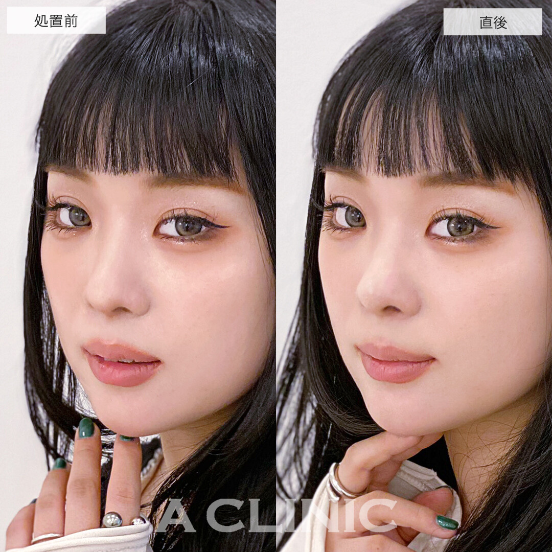 コリアンノーズでメリハリのある美人顔に！処置前と直後の症例です(30代女性)