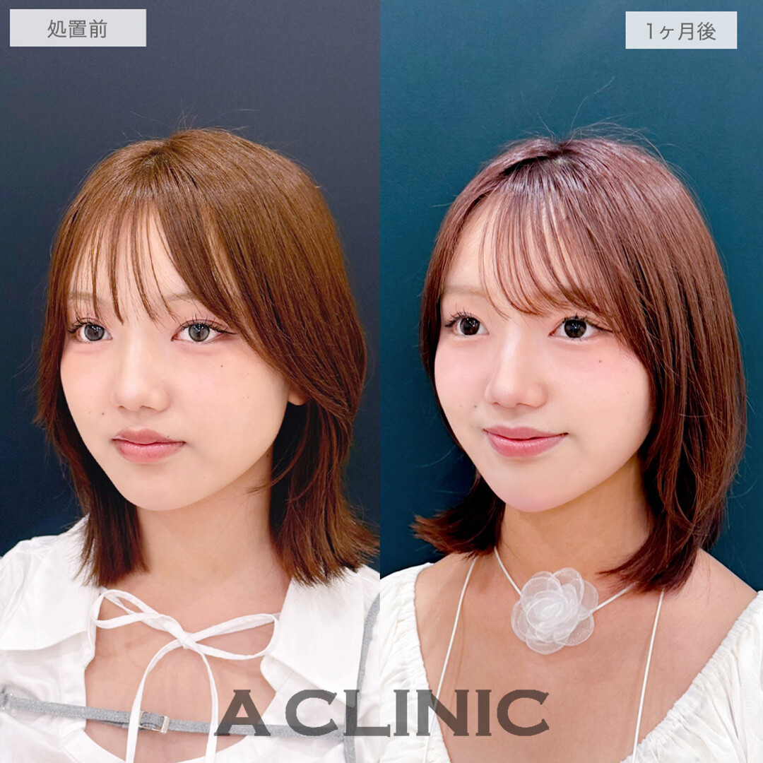 1day小顔脂肪吸引とあごへのヒアルロン酸注入でお顔の余白がなくなりシャープな輪郭になりました！処置前と1ヶ月後の症例です(20代女性)