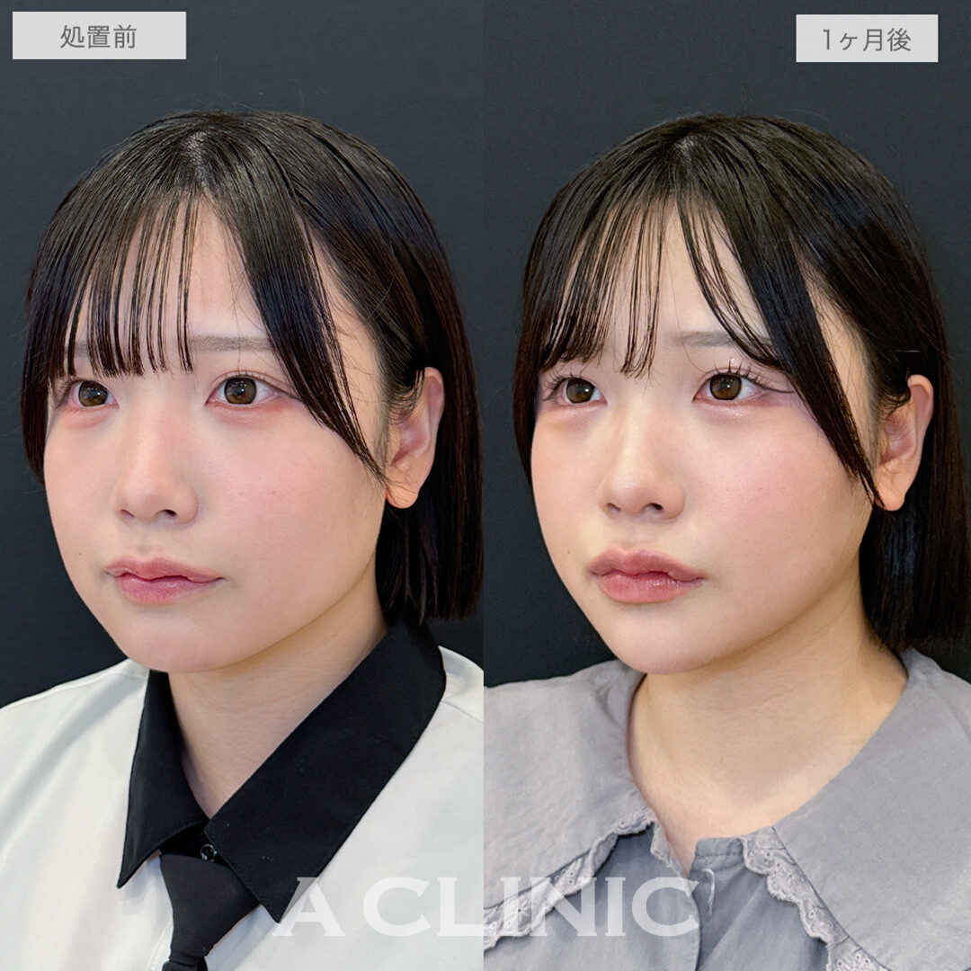 1day小顔脂肪吸引と小顔エラボトックスとあごへのヒアルロン酸注入とボトックス注射(しわ)でどこから見られても怖くないシャープな輪郭に！処置前と1ヶ月後の症例です(20代女性)