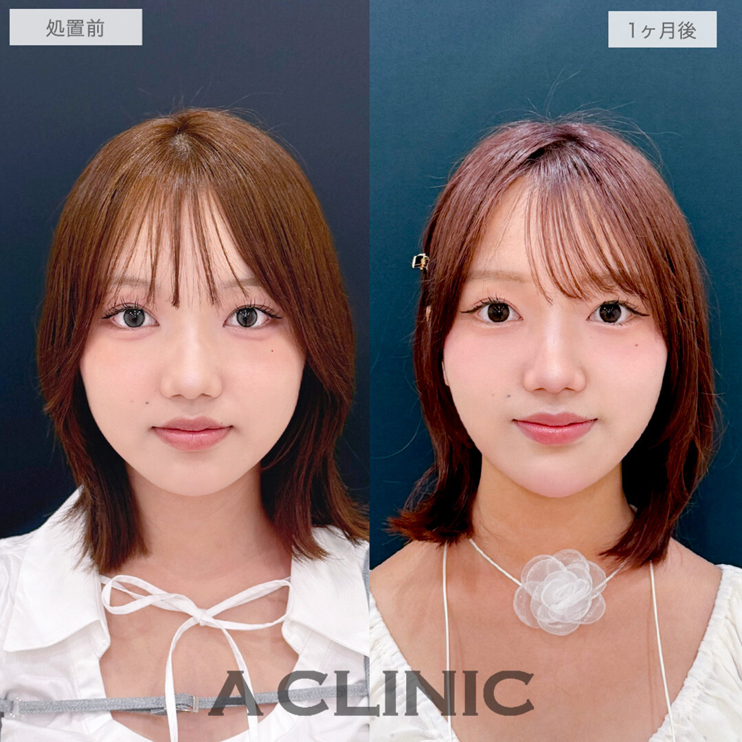 1day小顔脂肪吸引とあごへのヒアルロン酸注入でお顔の余白がなくなりシャープな輪郭になりました！処置前と1ヶ月後の症例です(20代女性)
