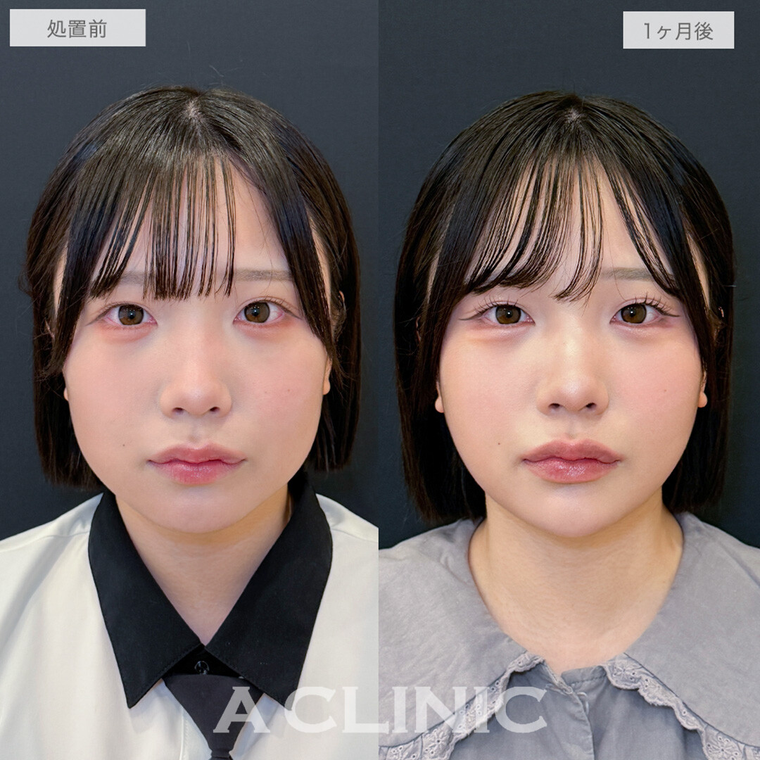 1day小顔脂肪吸引と小顔エラボトックスとあごへのヒアルロン酸注入とボトックス注射(しわ)でどこから見られても怖くないシャープな輪郭に！処置前と1ヶ月後の症例です(20代女性)