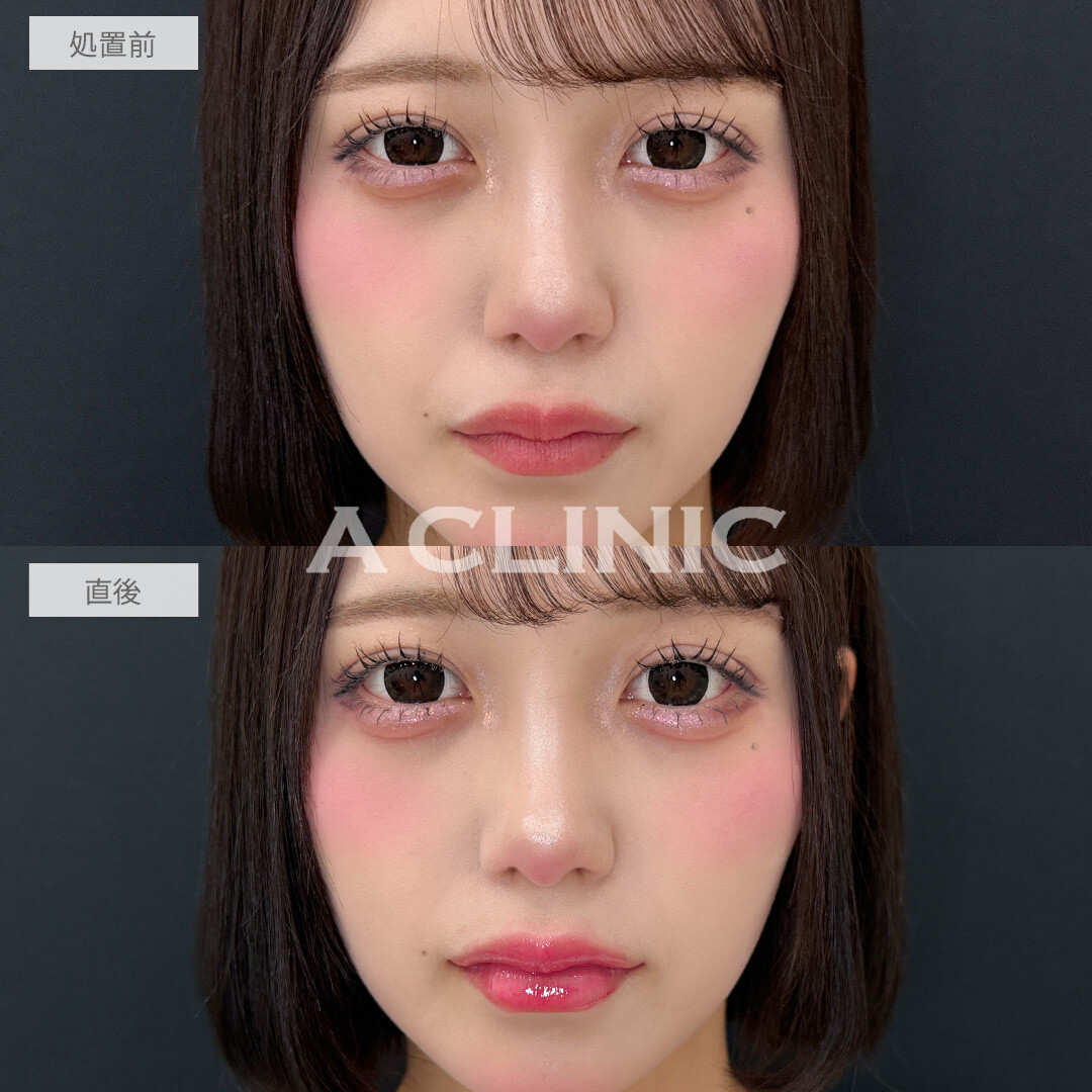 ヒアルで中顔面短縮してバブみ増し！涙袋形成術(ヒアルロン酸)とリップヒアルロン酸注入の処置前と直後の症例です(20代女性)