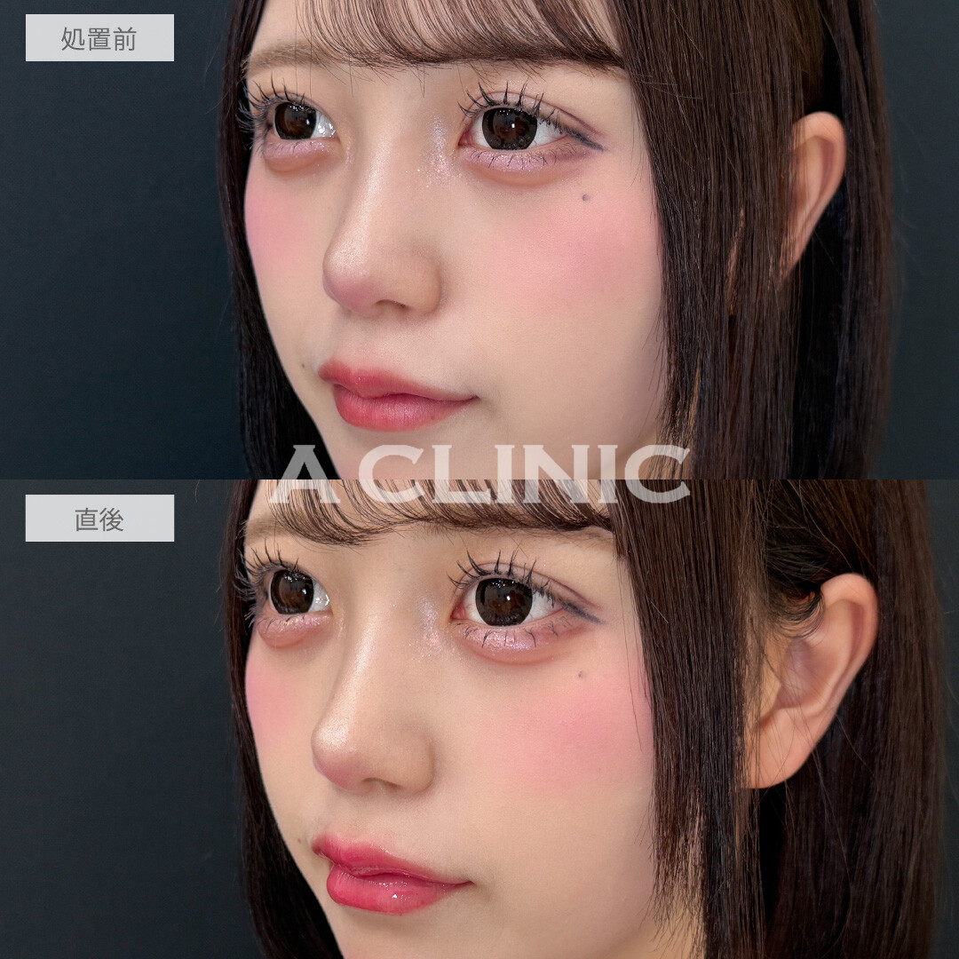ヒアルで中顔面短縮してバブみ増し！涙袋形成術(ヒアルロン酸)とリップヒアルロン酸注入の処置前と直後の症例です(20代女性)