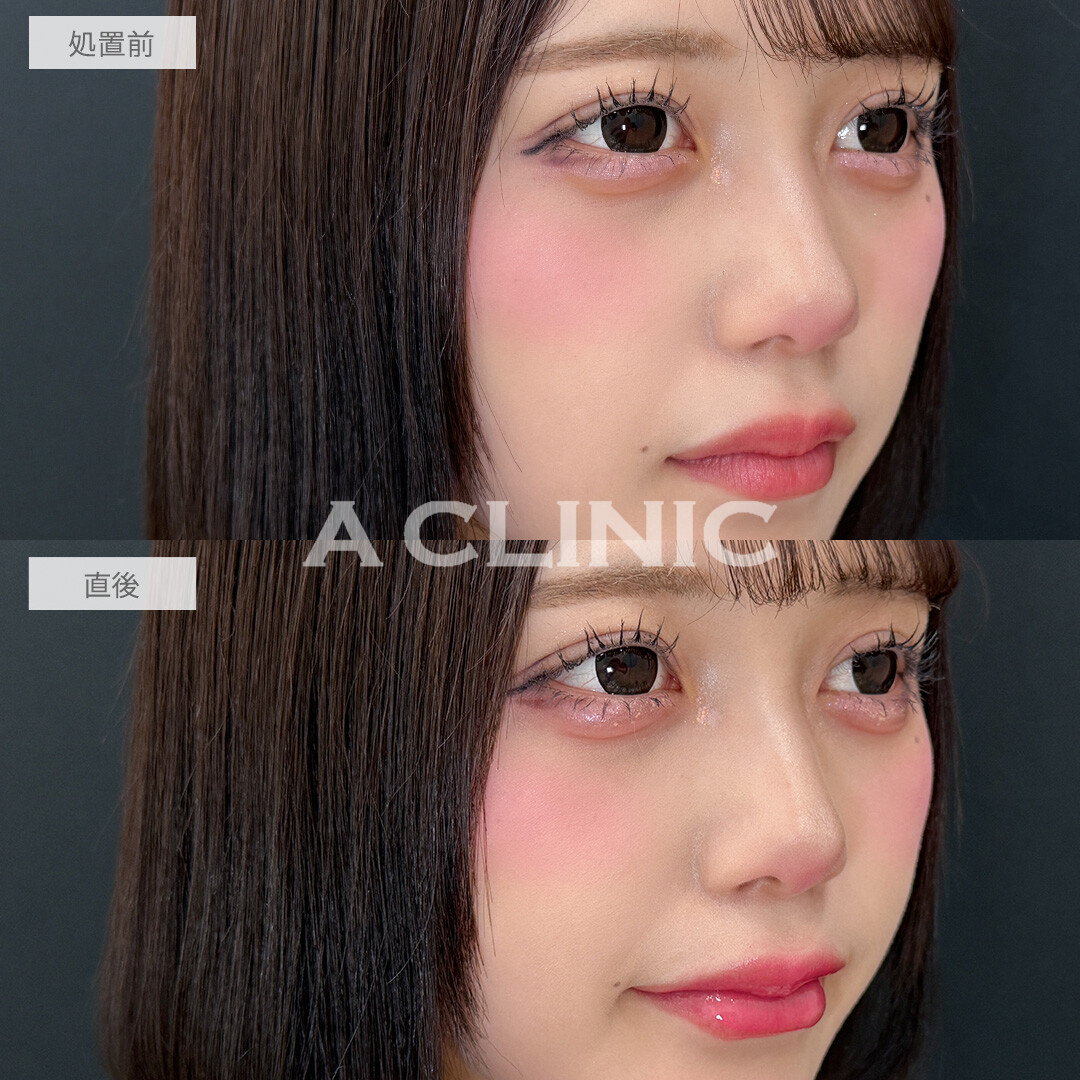 ヒアルで中顔面短縮してバブみ増し！涙袋形成術(ヒアルロン酸)とリップヒアルロン酸注入の処置前と直後の症例です(20代女性)