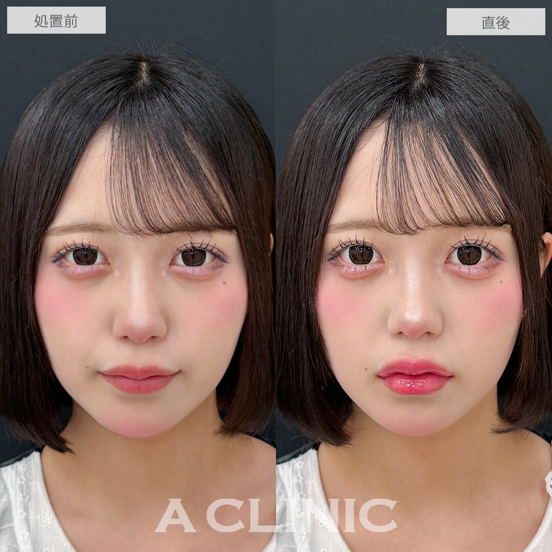 ヒアルで中顔面短縮してバブみ増し！涙袋形成術(ヒアルロン酸)とリップヒアルロン酸注入の処置前と直後の症例です(20代女性)