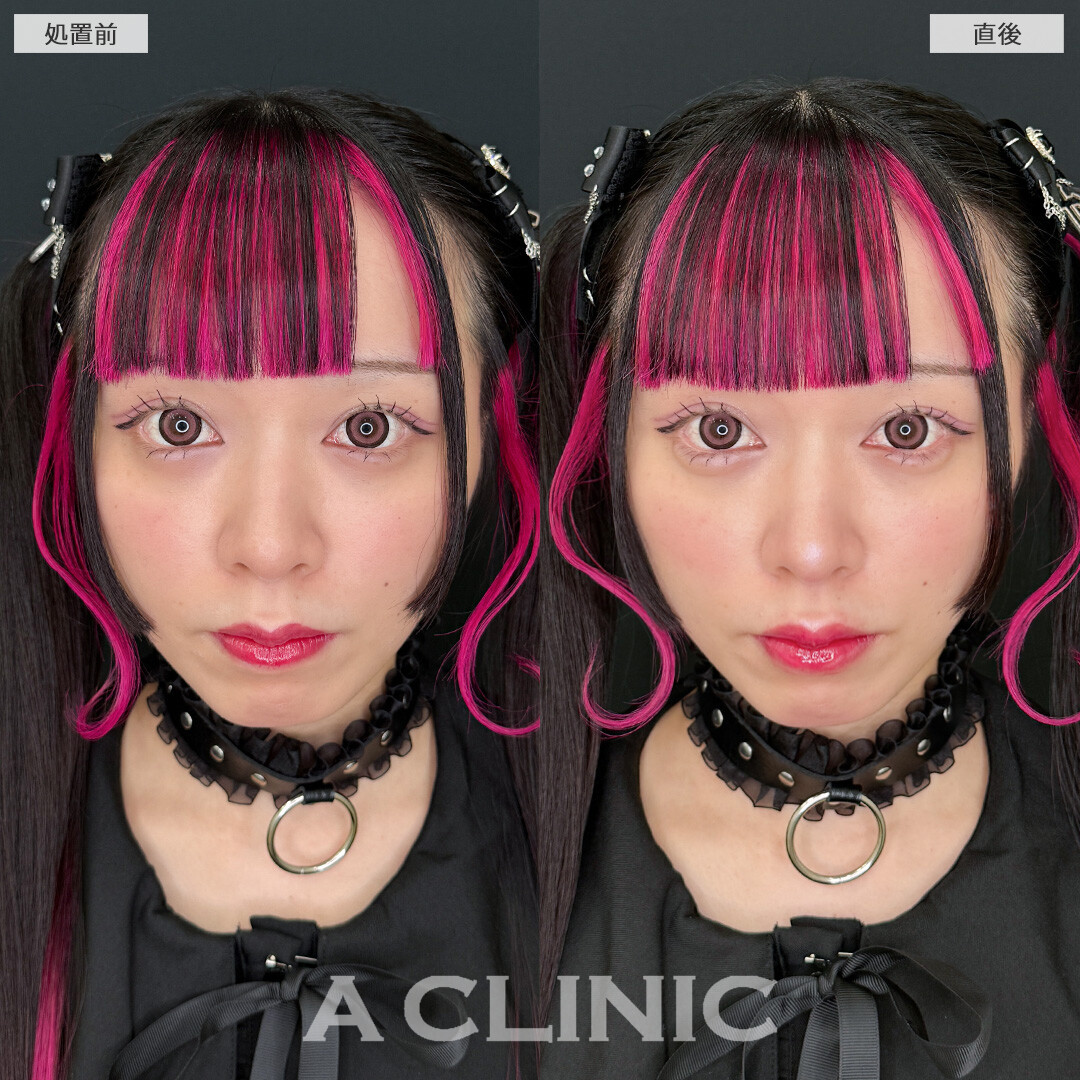 ヒアルだけでお手軽に中顔面を短縮できます！涙袋形成術(ヒアルロン酸)とリップヒアルロン酸注入の処置前と直後の症例です(20代女性)