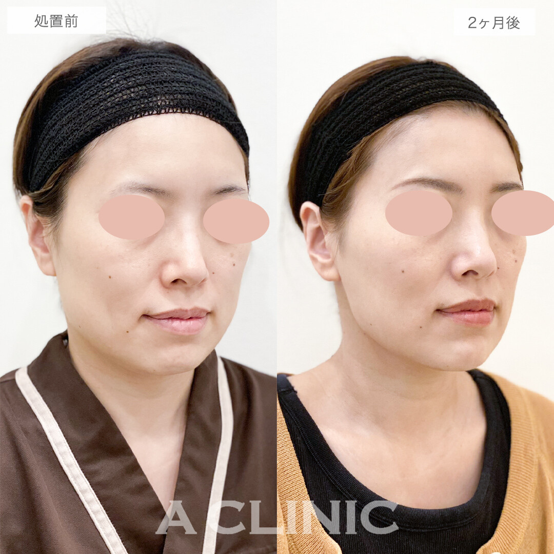 1day小顔脂肪吸引と小顔エラボトックスでスッキリフェイスライン！処置前と2ヶ月後の症例です(40代女性)