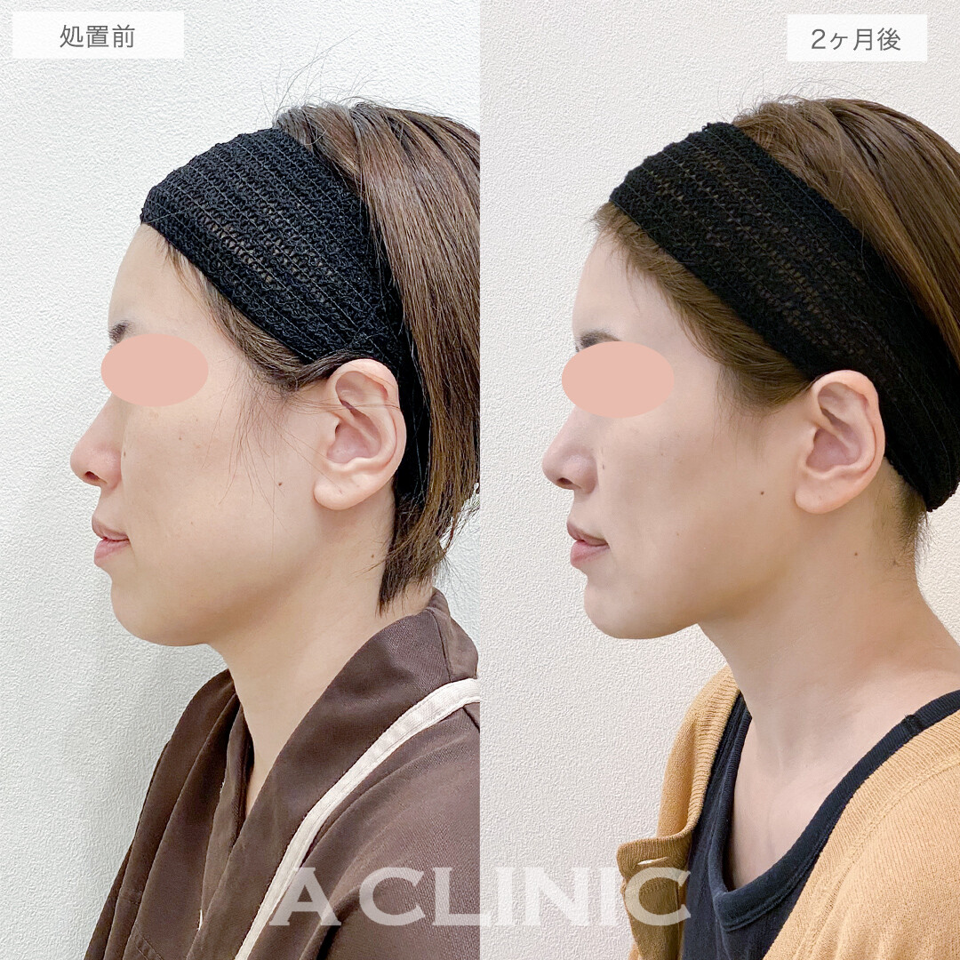 1day小顔脂肪吸引と小顔エラボトックスでスッキリフェイスライン！処置前と2ヶ月後の症例です(40代女性)