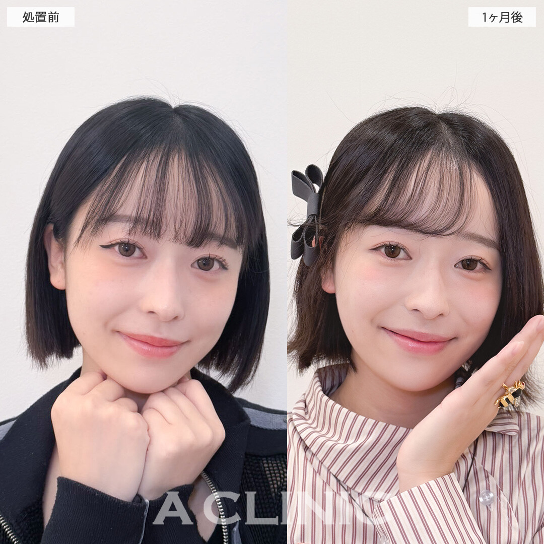 1day小顔脂肪吸引で印象に残る小顔に！こちら処置前と1ヶ月後の症例です(20代女性)