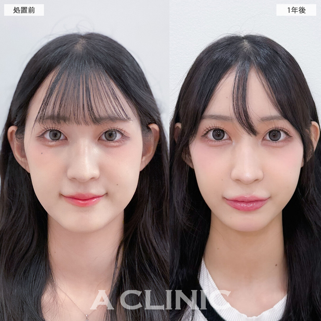 1day小顔脂肪吸引は1年後もリバウンドなく小顔のまま！こちら処置前と1年後の症例です(10代女性)