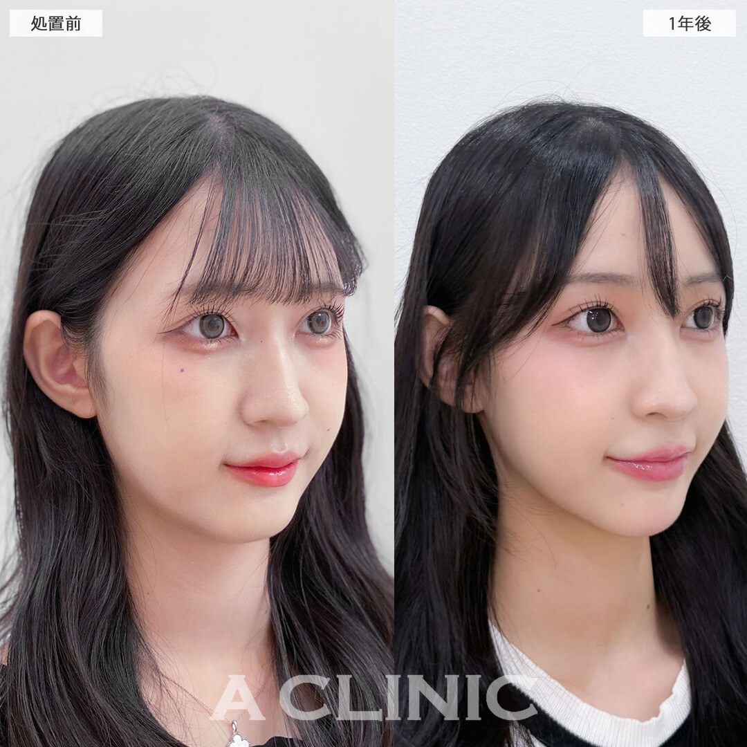 1day小顔脂肪吸引は1年後もリバウンドなく小顔のまま！こちら処置前と1年後の症例です(10代女性)