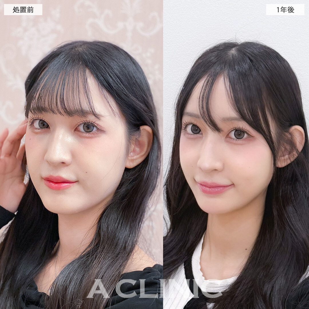 1day小顔脂肪吸引は1年後もリバウンドなく小顔のまま！こちら処置前と1年後の症例です(10代女性)