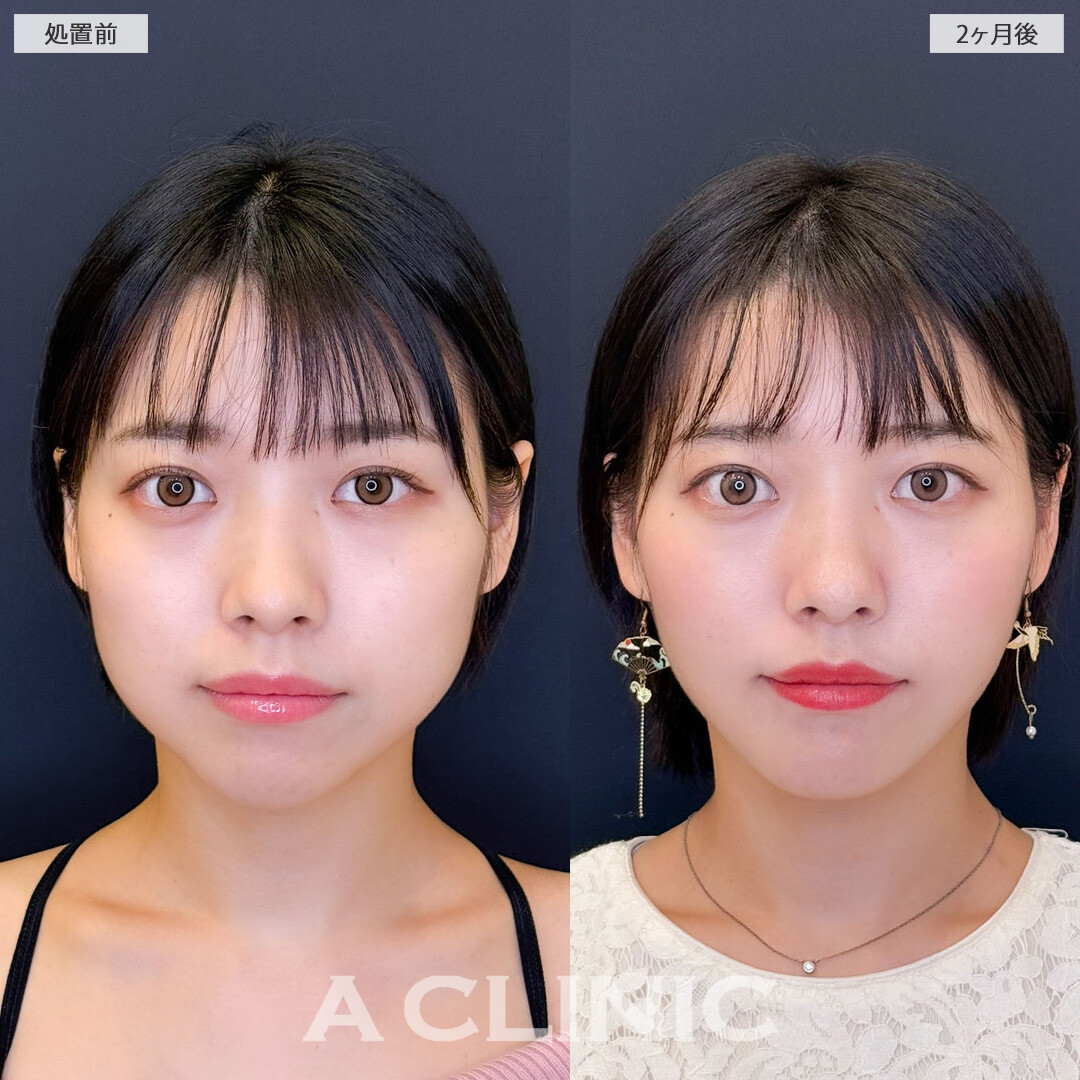 1day小顔脂肪吸引と小顔エラボトックスで輪郭が整い垢抜けました！こちら処置前と2ヶ月後の症例です(20代女性)
