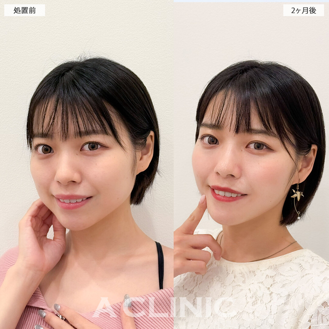 1day小顔脂肪吸引と小顔エラボトックスで輪郭が整い垢抜けました！こちら処置前と2ヶ月後の症例です(20代女性)