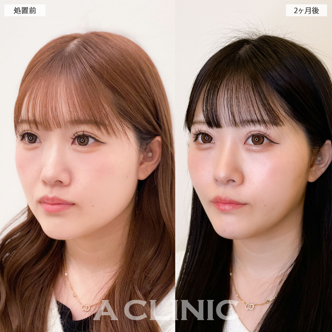 1day小顔脂肪吸引で輪郭を整えてさらに可愛くなりました！こちら処置前と2ヶ月後の症例です(20代女性)