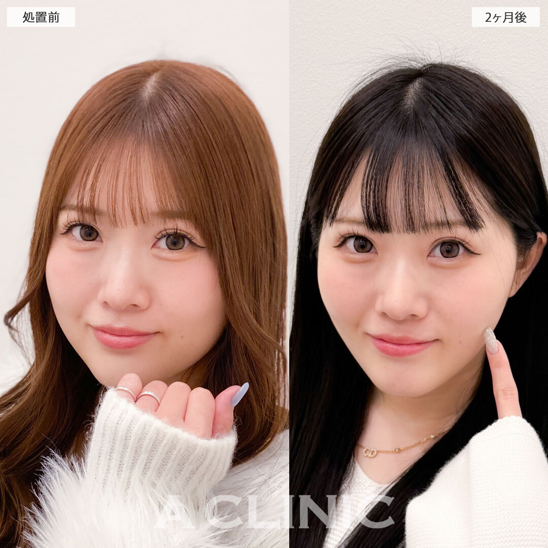 1day小顔脂肪吸引で輪郭を整えてさらに可愛くなりました！こちら処置前と2ヶ月後の症例です(20代女性)