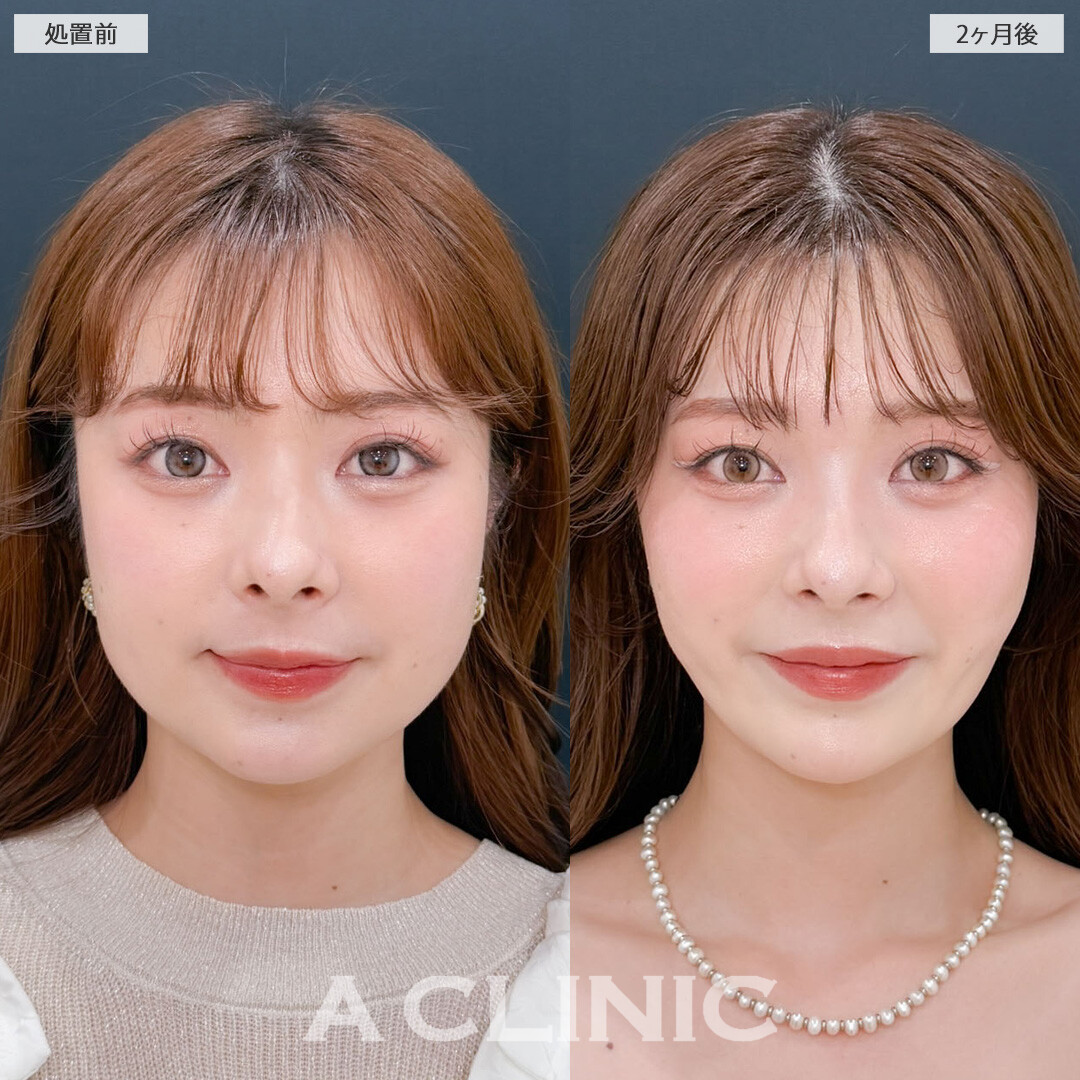 1day小顔脂肪吸引とバッカルファット除去術で圧倒的な小顔美人になりました！こちら処置前と2ヶ月後の症例です(20代女性)