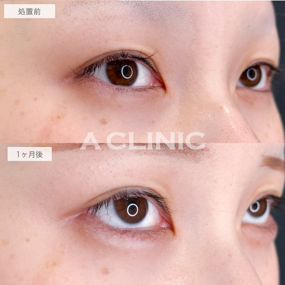 パーフェクトアイズでかわいすぎるお目元に！処置前と1ヶ月後の症例です(20代女性)