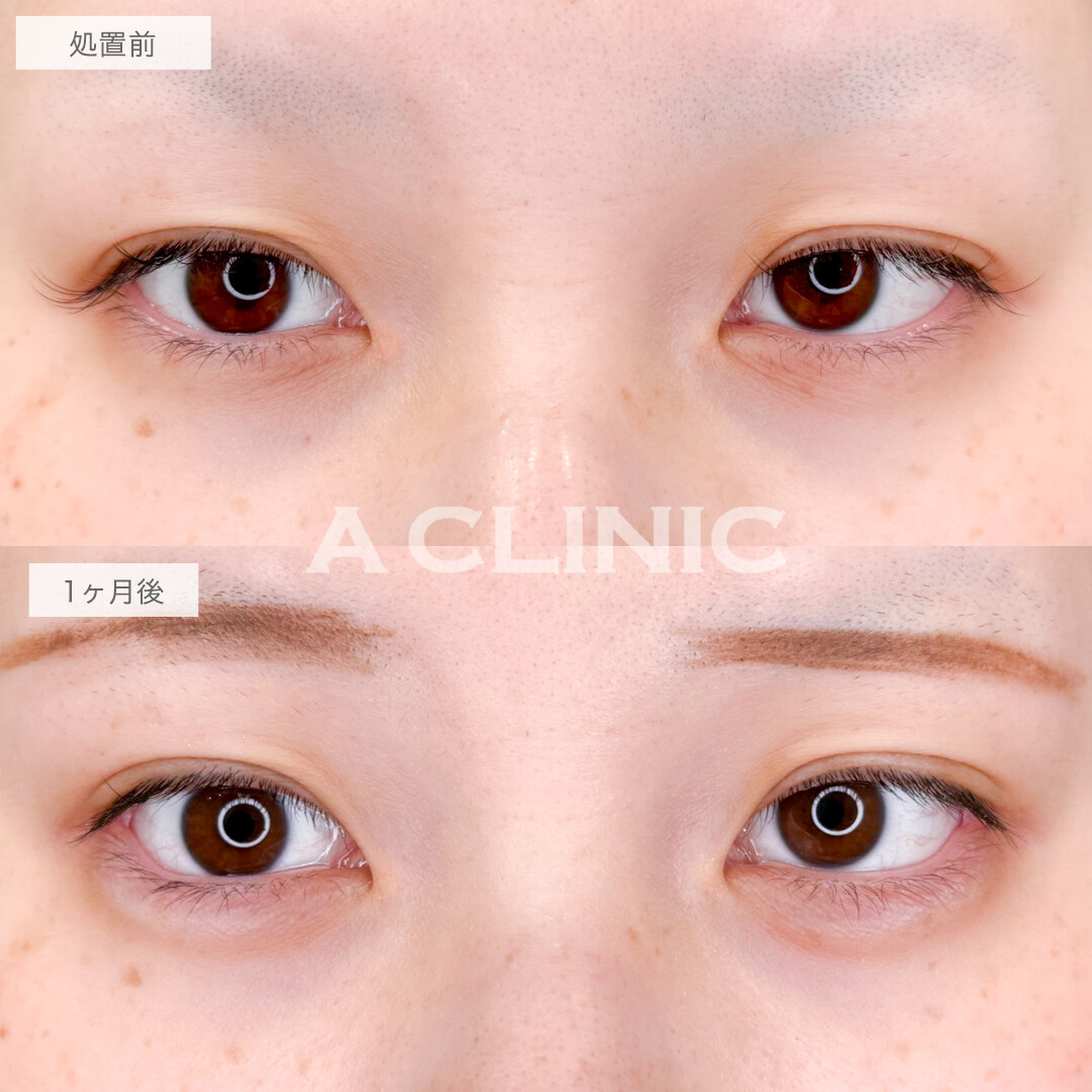 パーフェクトアイズでかわいすぎるお目元に！処置前と1ヶ月後の症例です(20代女性)