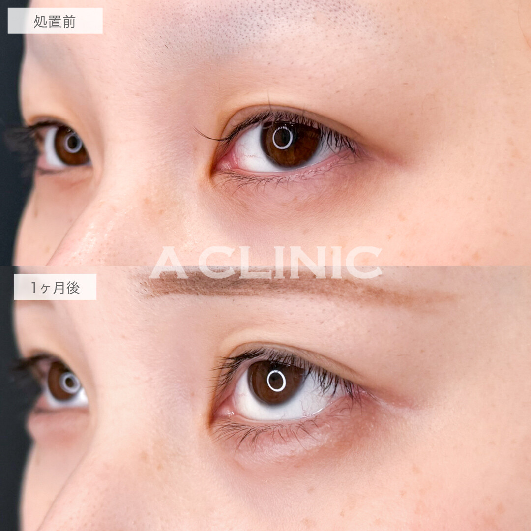 パーフェクトアイズでかわいすぎるお目元に！処置前と1ヶ月後の症例です(20代女性)