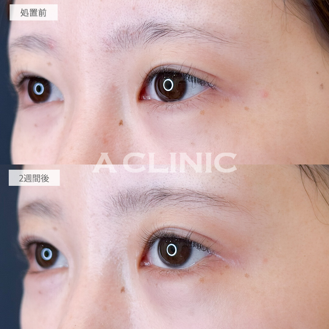 パーフェクトアイズで目元が大きく華やかになりました！処置前と2週間後の症例です(20代女性)