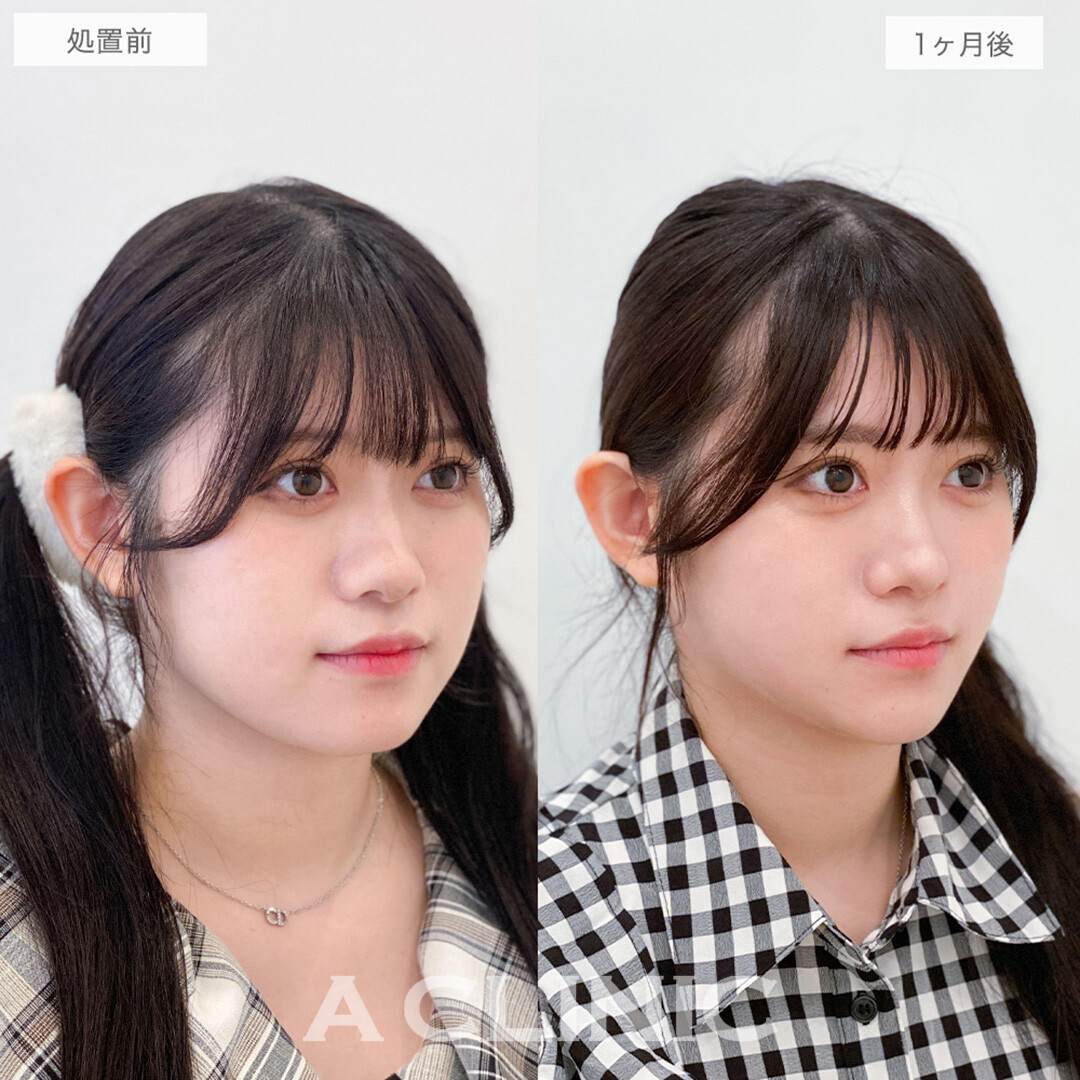 1day小顔脂肪吸引で丸顔からVフェイス美女に大変身！処置前と1ヶ月後の症例です(20代女性)