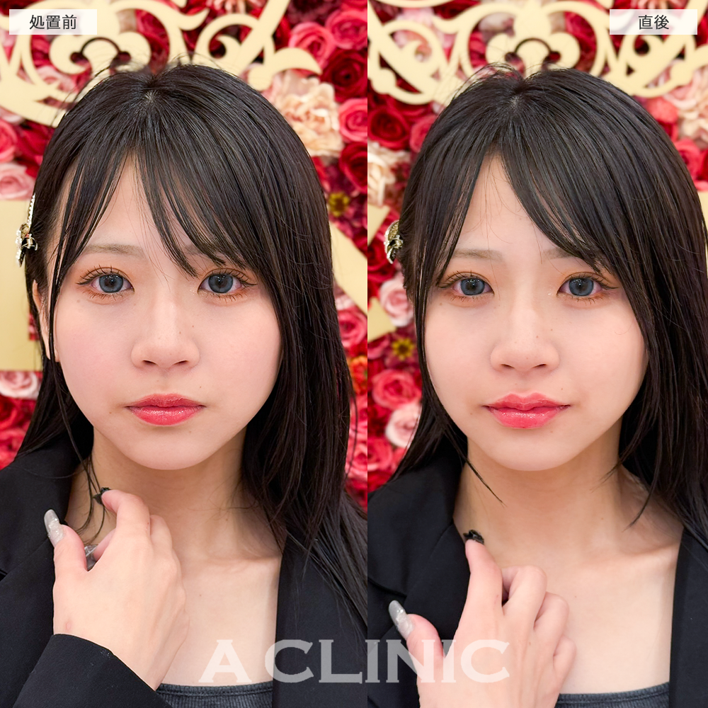 スマイルリップで唇のボリュームUPして人中も短く見えるようになりました！こちら処置前と直後の症例です(20代女性)