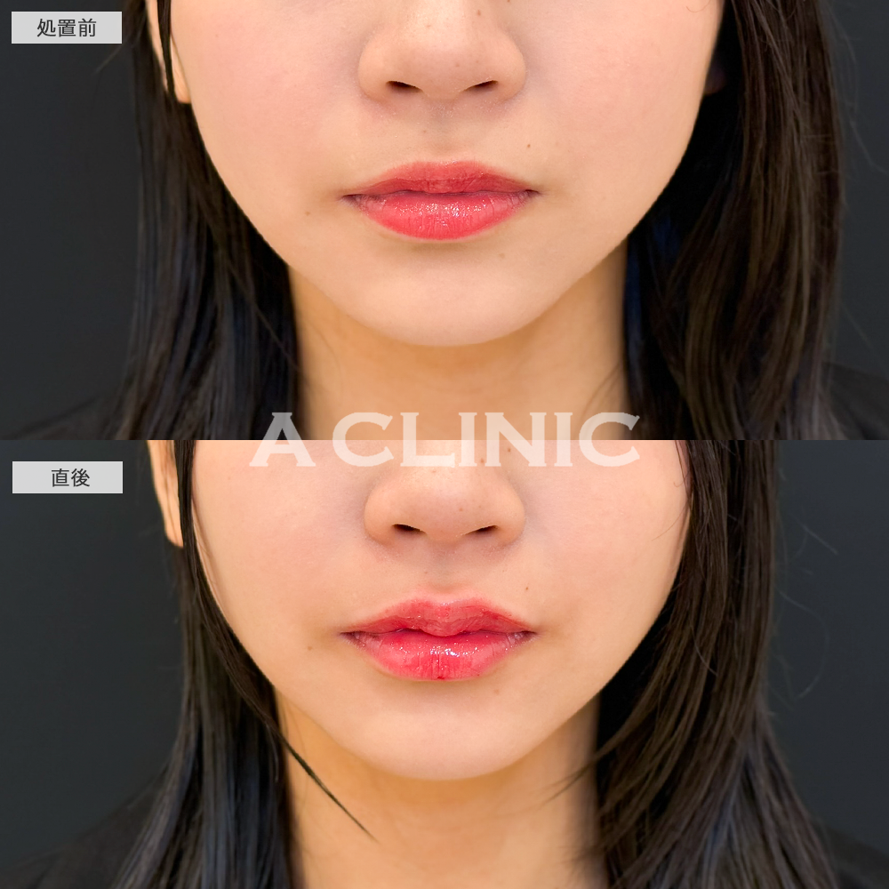 スマイルリップで唇のボリュームUPして人中も短く見えるようになりました！こちら処置前と直後の症例です(20代女性)