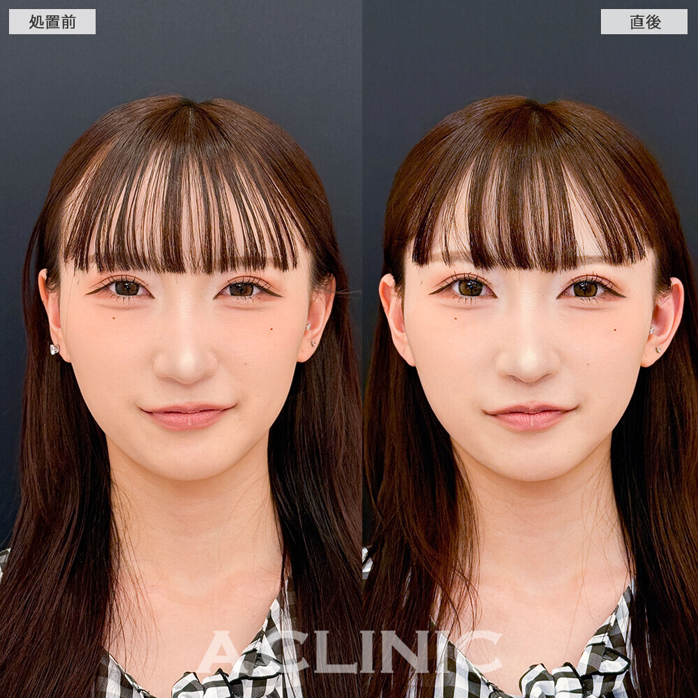 立ち耳ヒアルロン酸注入(ボリューマー)で顔の余白が減り小顔に！こちら処置前と直後の症例です。(20代女性)