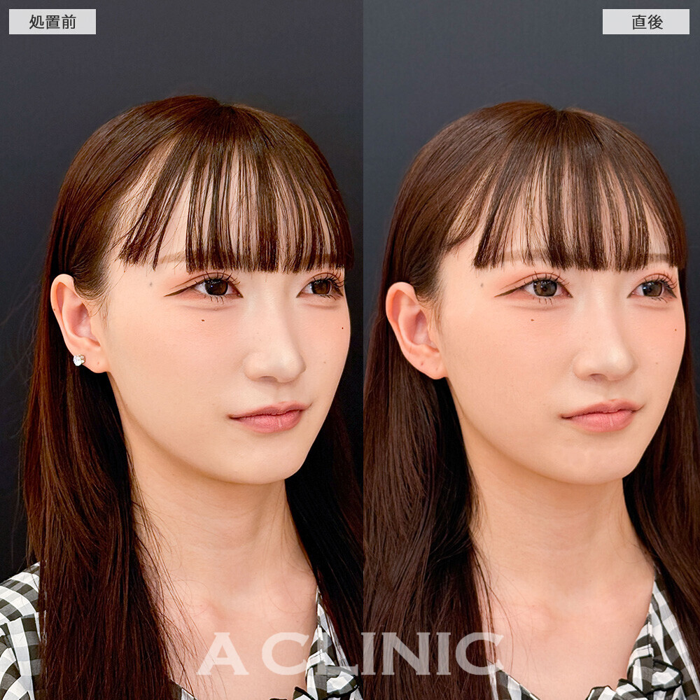 立ち耳ヒアルロン酸注入(ボリューマー)で顔の余白が減り小顔に！こちら処置前と直後の症例です。(20代女性)