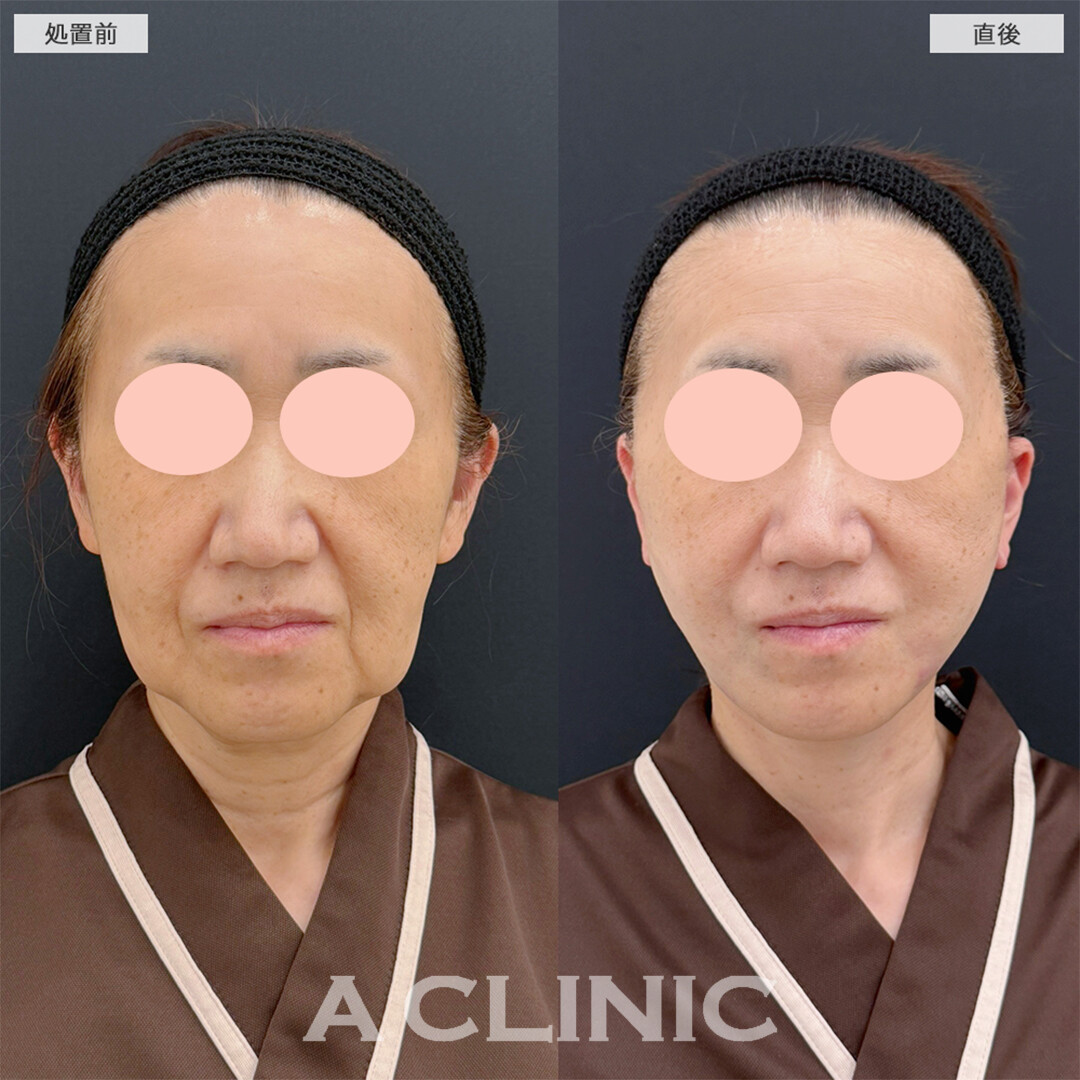 A式美肌たるみ切開は最強の若返り術！こちら処置前と直後の症例です(50代女性)