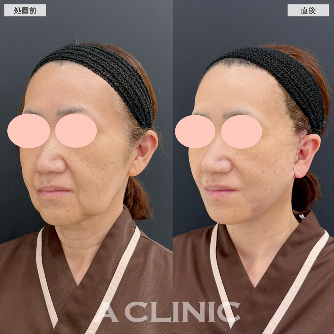 A式美肌たるみ切開は最強の若返り術！こちら処置前と直後の症例です(50代女性)