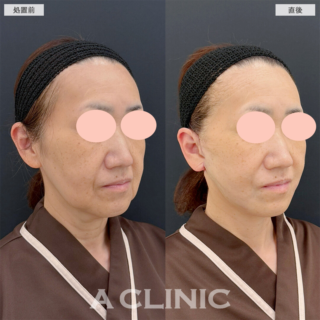 A式美肌たるみ切開は最強の若返り術！こちら処置前と直後の症例です(50代女性)