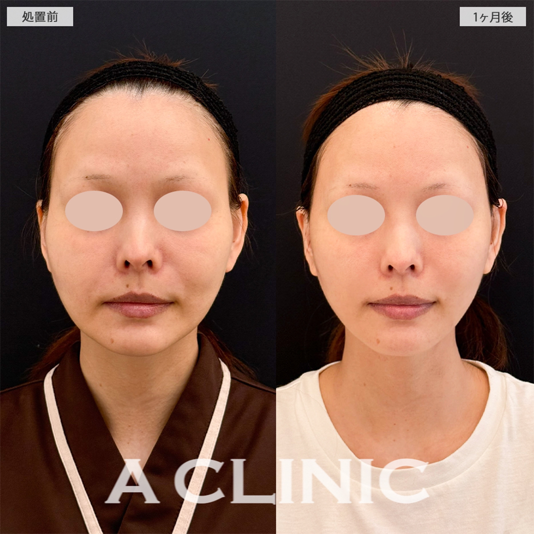 A式美肌たるみ切開でお悩みだった輪郭のたるみが解消され若返り成功！こちら処置前と1ヶ月後の症例です(40代女性)
