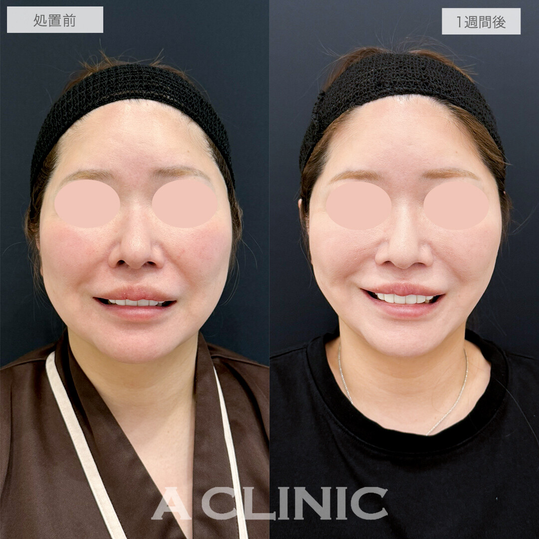 A式美肌たるみ切開と1day小顔脂肪吸引で若々しくシャープな輪郭になりました！処置前と1週間後の症例です(40代女性)