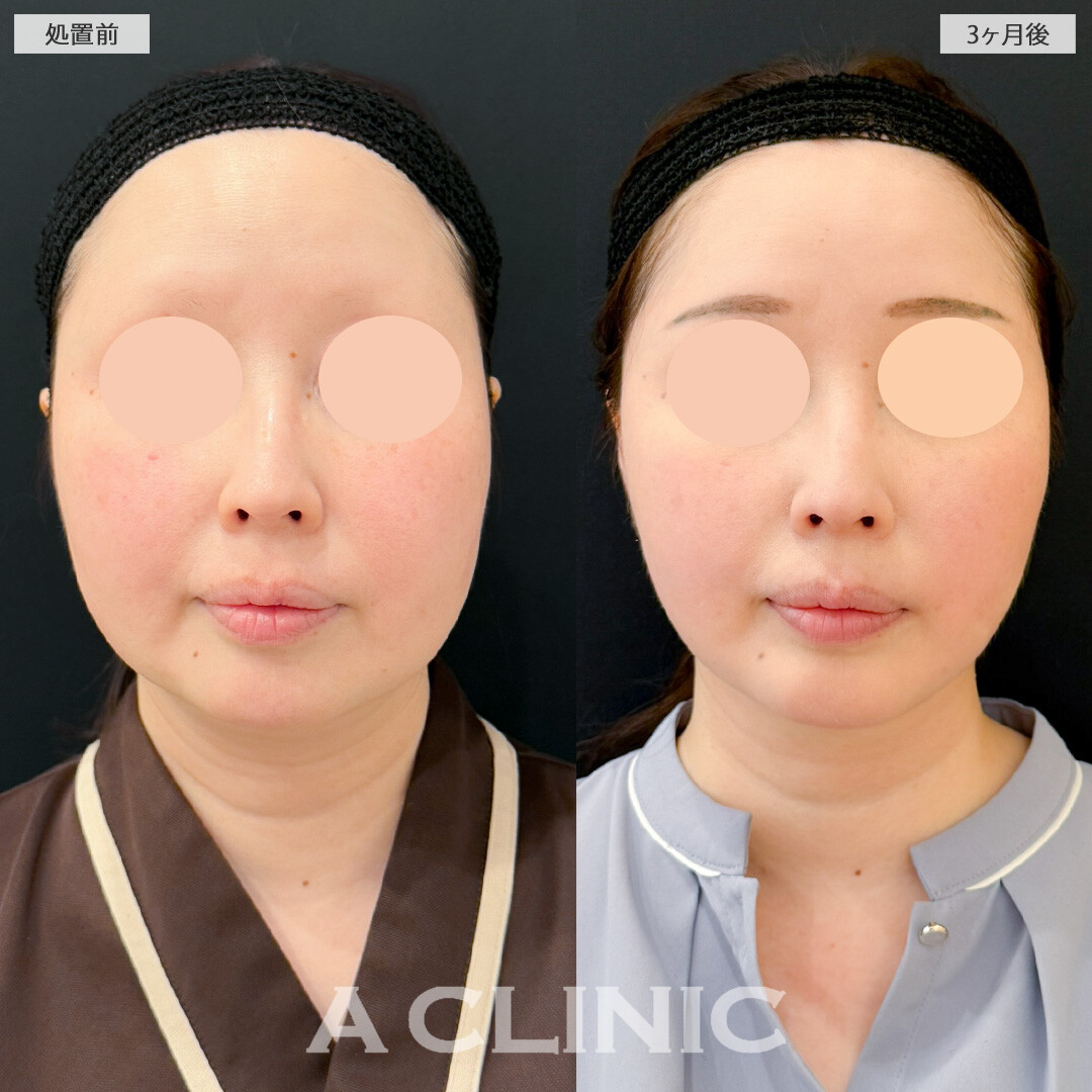 1day小顔脂肪吸引とA式美肌たるみ切開で輪郭が劇的変化！処置前と3ヶ月後の症例です(30代女性)