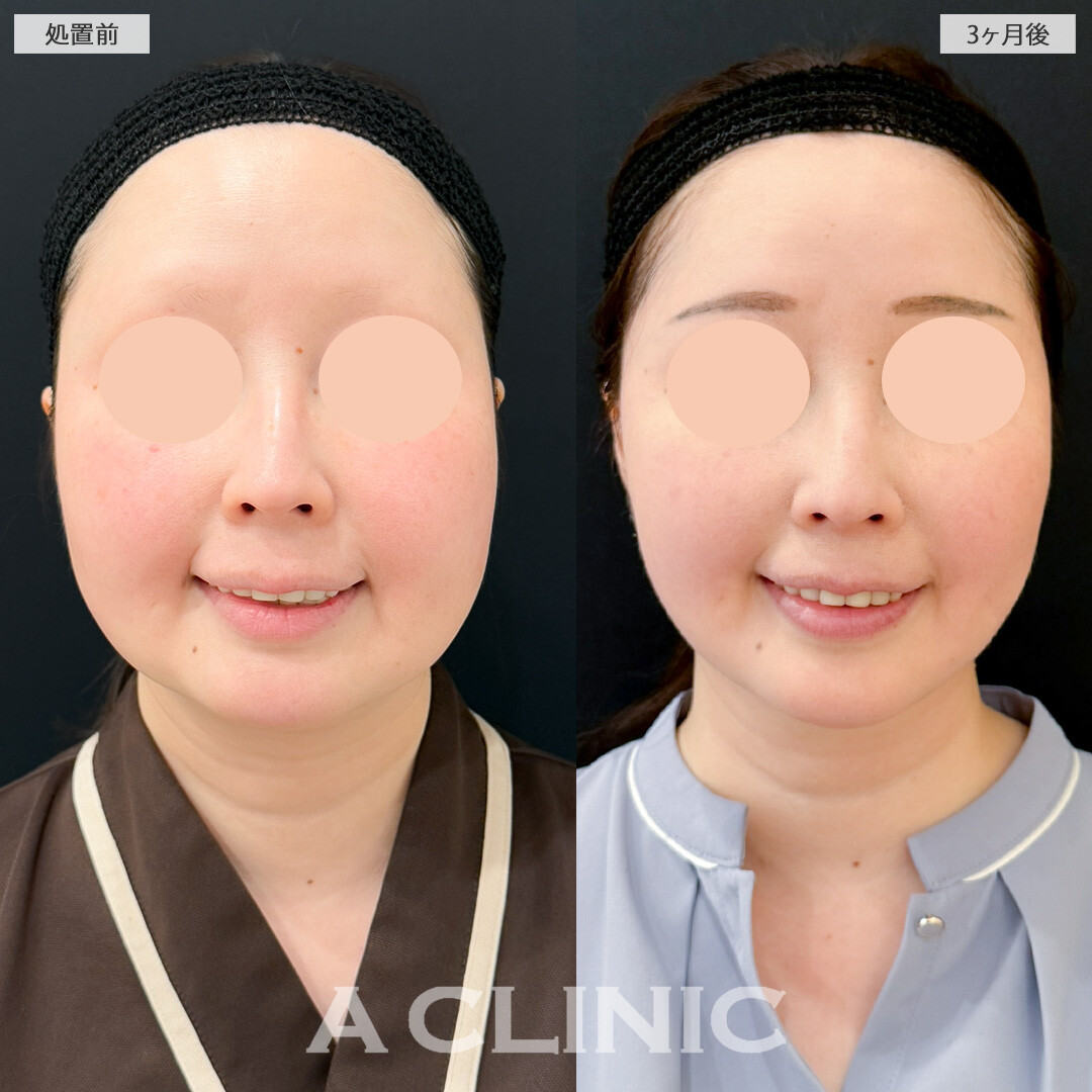 1day小顔脂肪吸引とA式美肌たるみ切開で輪郭が劇的変化！処置前と3ヶ月後の症例です(30代女性)