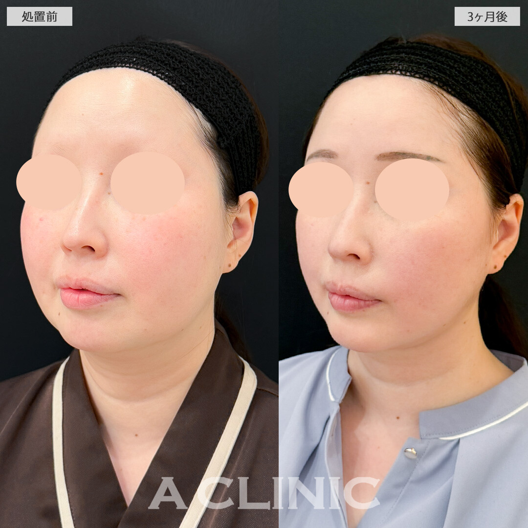 1day小顔脂肪吸引とA式美肌たるみ切開で輪郭が劇的変化！処置前と3ヶ月後の症例です(30代女性)