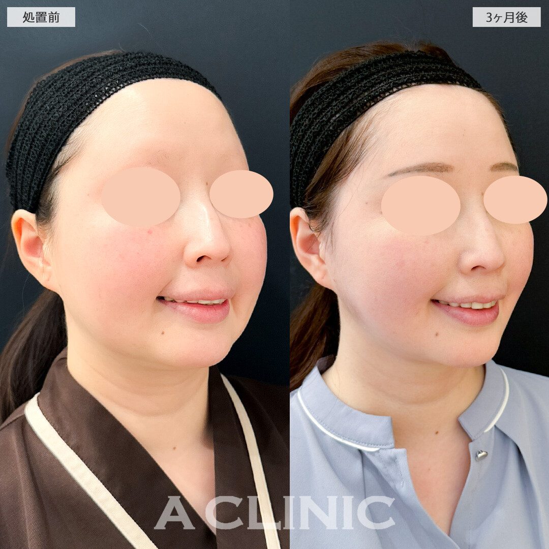 1day小顔脂肪吸引とA式美肌たるみ切開で輪郭が劇的変化！処置前と3ヶ月後の症例です(30代女性)