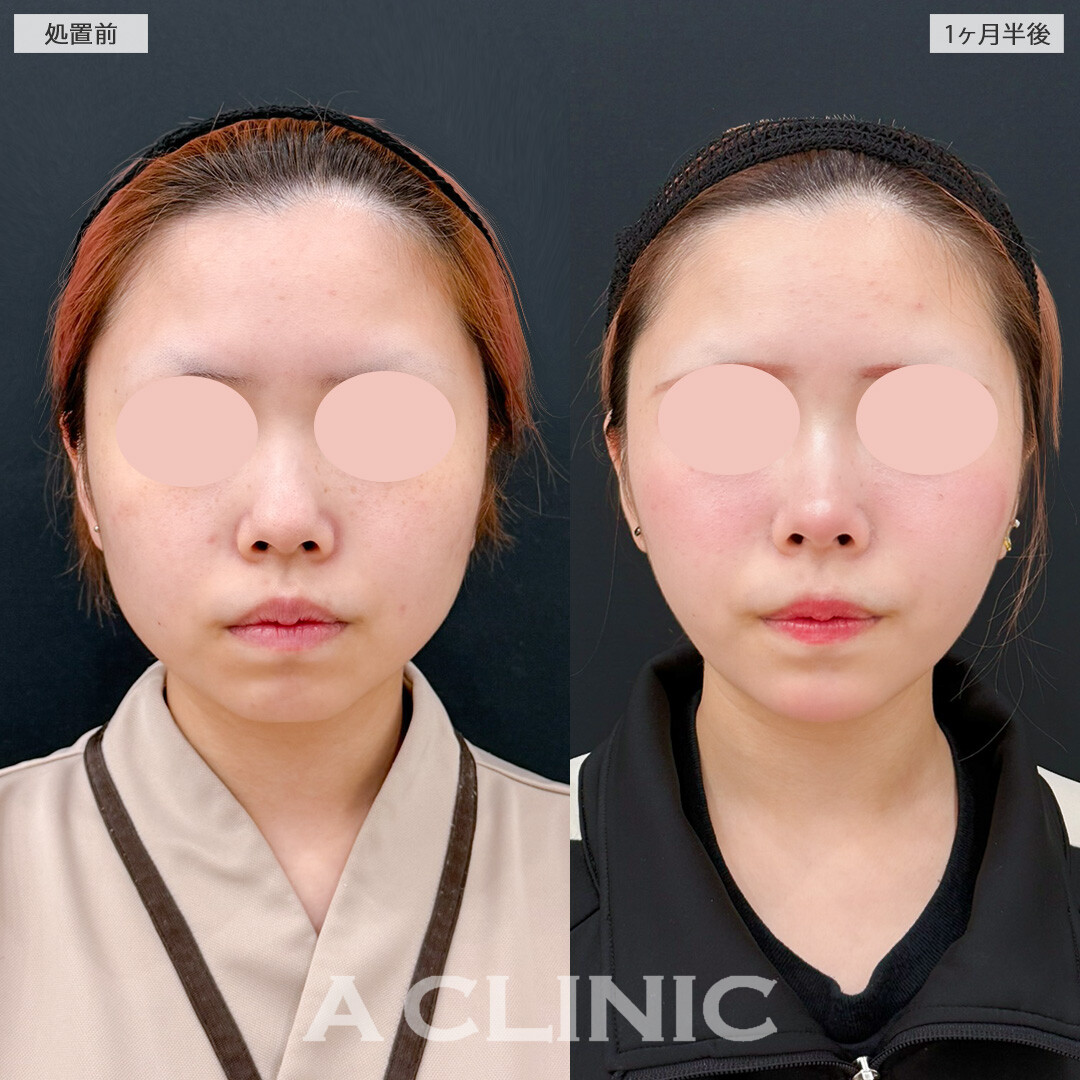 1day小顔脂肪吸引とあごへのヒアルロン酸注入で一気に垢抜けた印象に！処置前と1ヶ月半後の症例です(10代女性)
