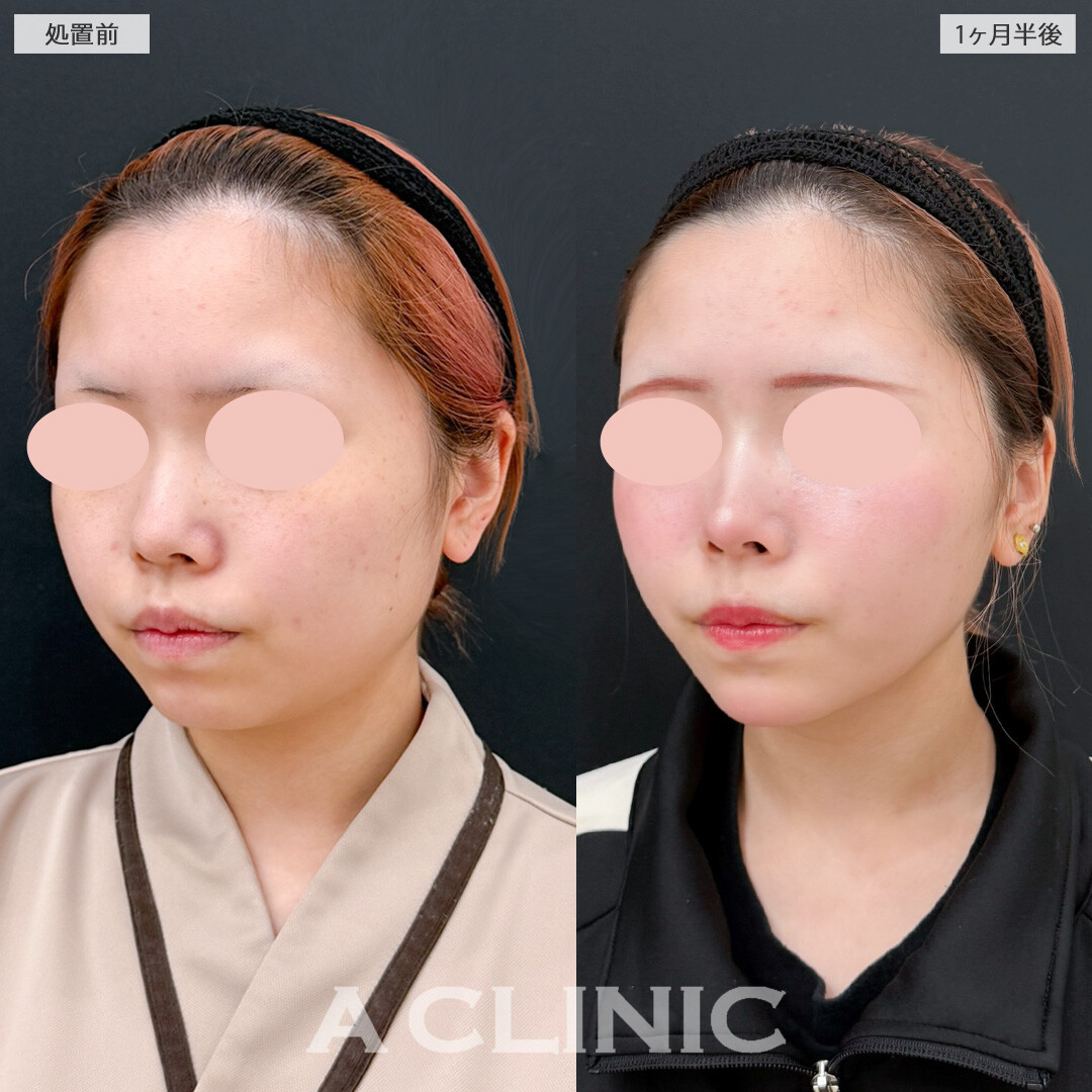 1day小顔脂肪吸引とあごへのヒアルロン酸注入で一気に垢抜けた印象に！処置前と1ヶ月半後の症例です(10代女性)