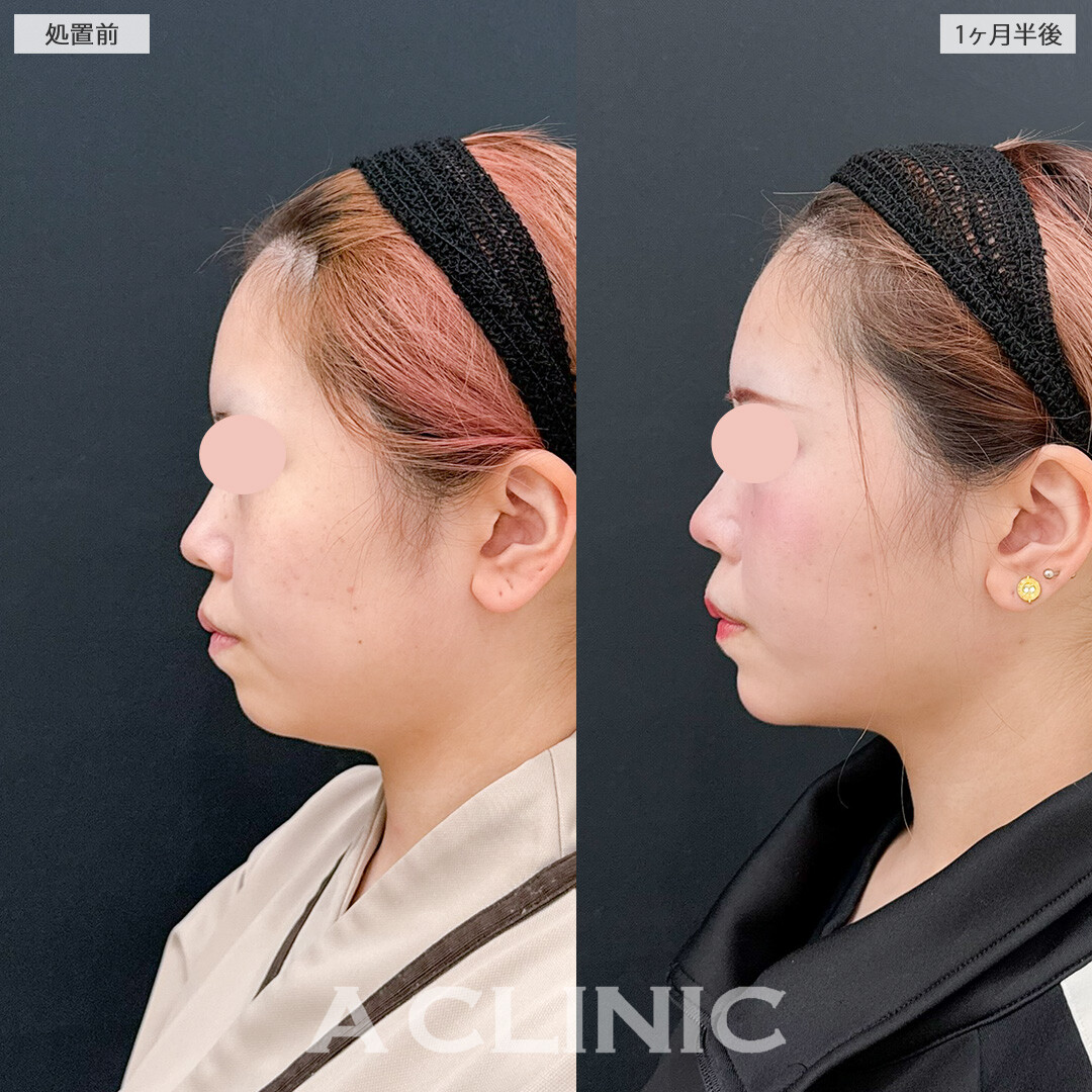 1day小顔脂肪吸引とあごへのヒアルロン酸注入で一気に垢抜けた印象に！処置前と1ヶ月半後の症例です(10代女性)