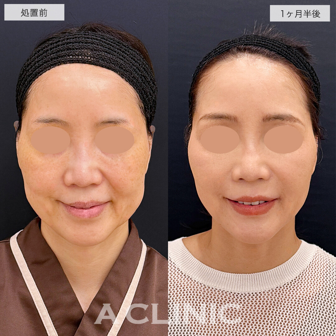 1day小顔脂肪吸引とバッカルファット除去、ほうれい線へのヒアルロン酸注射でナチュラルに上品な若返りへ!処置前と1ヶ月半後の症例です(40代女性)